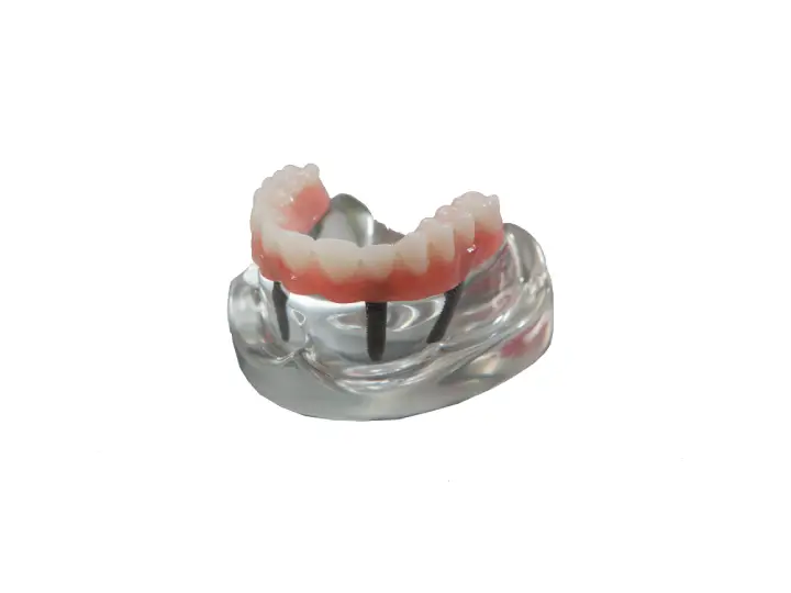 Nobel Biocare All-on-4 Speedy Groovy implant konsepti ve tam ark sabit protez